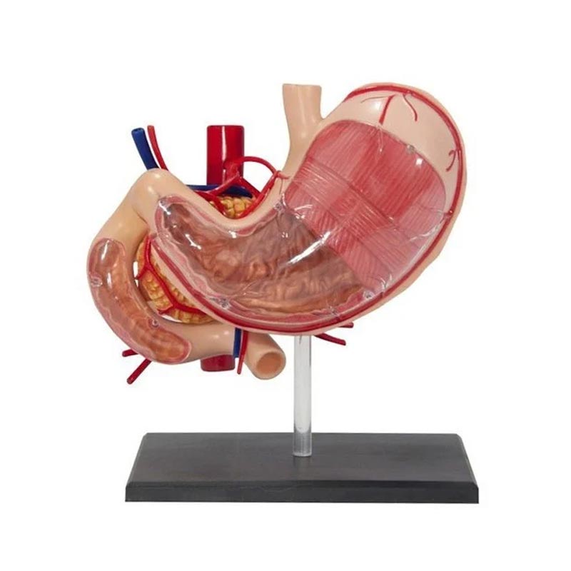 Metastatic Tumor Ovary, Stomach Model