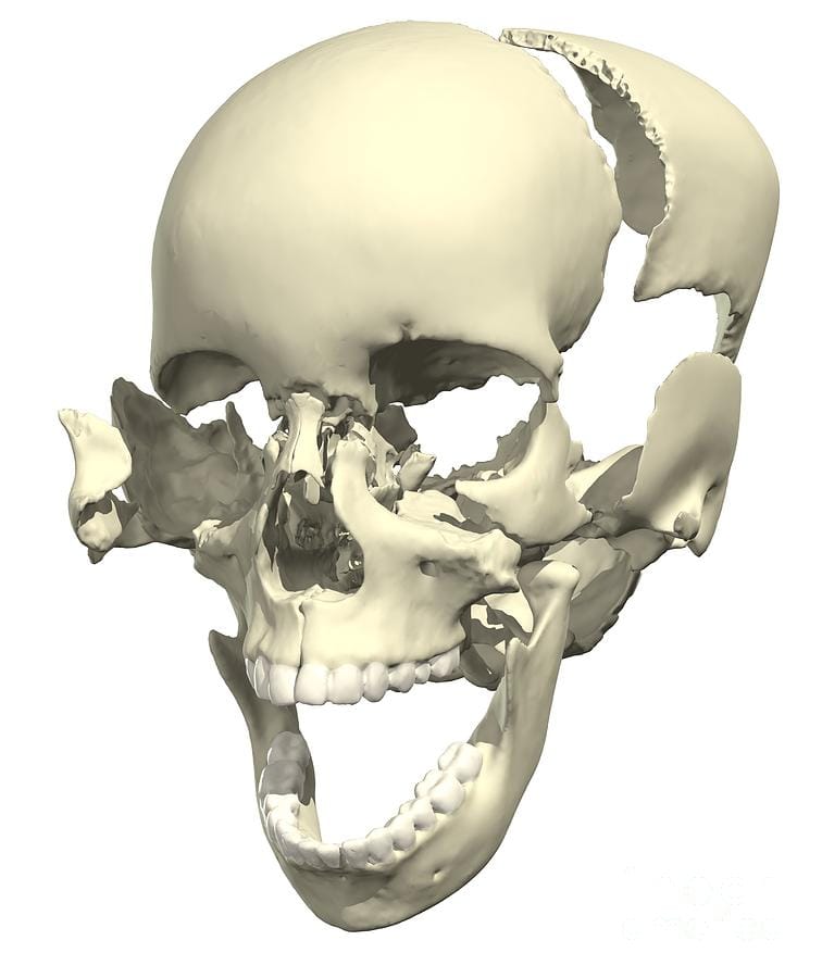 Disanticulated