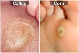 Callous